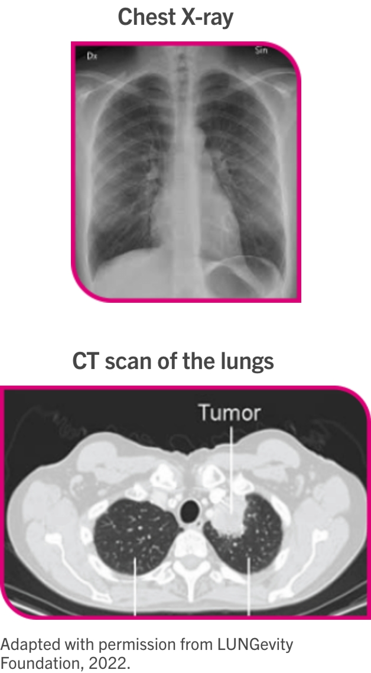 lung cancer cat scan