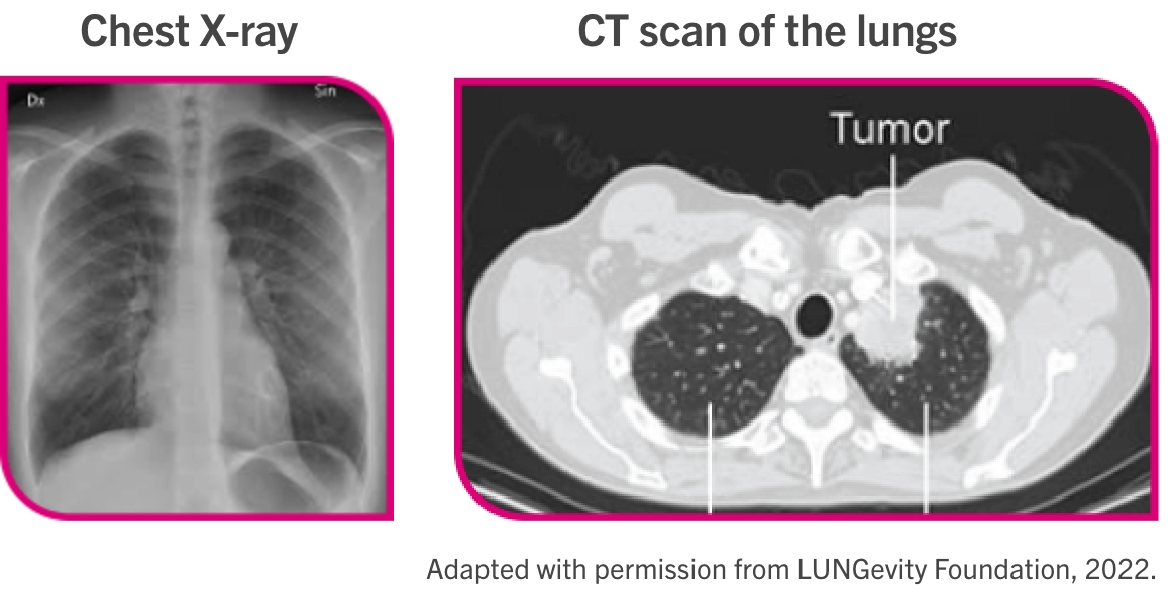 Small Cell vs. Non-Small Cell Lung Cancer